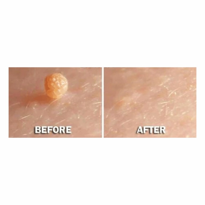 Skin Perfect Skin Tag & Wart Remover , , large