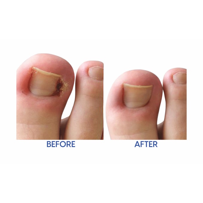 Relief Now Ingrown Toenail Pain Reliever, , large