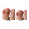 Relief Now Ingrown Toenail Pain Reliever, , large