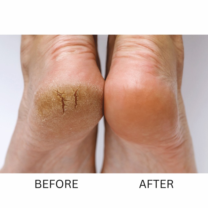 Foot Miracle Cracked-Heel Cream, , large