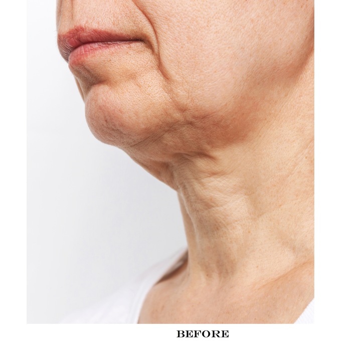 6-Pack Skin Firming Collagen & Hyaluronic Acid Chin Masks, , large