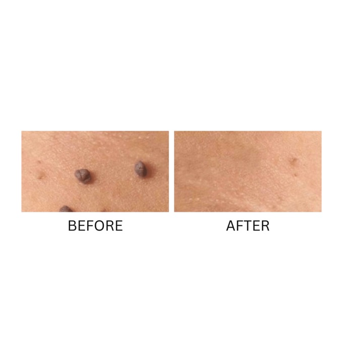 Skin Perfect Skin Tag & Wart Remover , , large