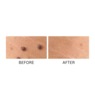 Skin Perfect Skin Tag & Wart Remover , , large